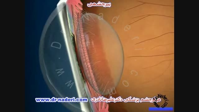 پیرچشمی - مرکز چشم پزشکی دکتر علیرضا نادری