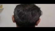 نمونه هائی از کاشت مو در کلینیک دکتر رضائی -قسمت دوم