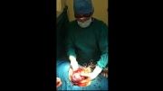 فیلم جراحی سرطان کلیه