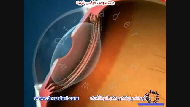 دیستروفی فوکس قرنیه -مرکز چشم پزشکی دکتر علیرضا نادری