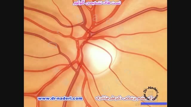 تست های تشخیصی گلوکوم-مرکز چشم پزشکی دکتر علیرضا نادری