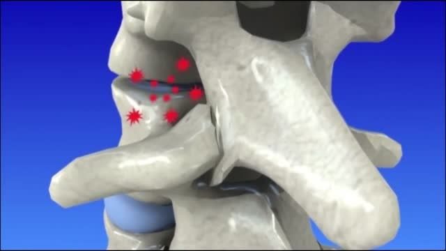تخریب دیسک بین مهره ای