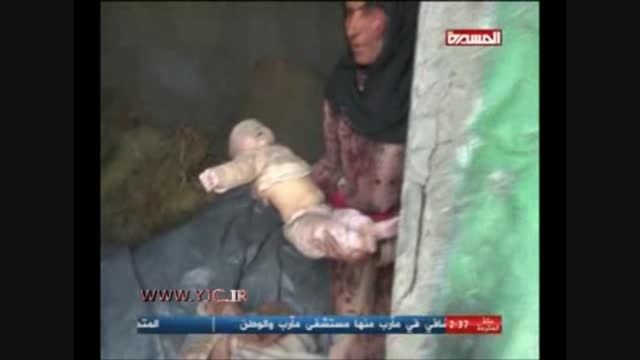 شهادت نوزاد 8 ماهه در یمن توسط آل سعود