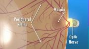 diabetic retinopathy 3