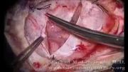 فیلم کامل جراحی تومور مغزی