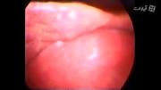 Hydatid Cyst Excision from Liver