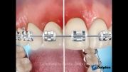 دکتر مسعود داودیان :: روش کشیدن نخ دندان ارتودنسی