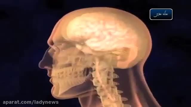 مختصری درباره ی سکته ی مغزی