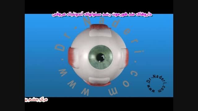 تزریق آواستین در ARMD -مرکز چشم پزشکی دکتر علیرضا نادری
