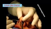 فیلم عمل جراحی زیبایی بینی-BM-ENG.IR
