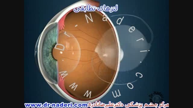 لنز داخل چشمی تطابقی - مرکز چشم پزشکی دکتر نادری