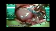 طپش  پرهیجان قلب  در یک عمل جراحی باز قلب(پزشکی)
