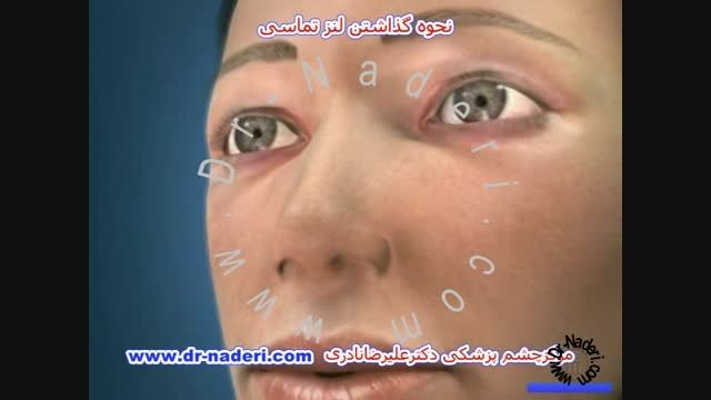 نحوه گذاشتن لنز تماسی- مرکز چشم پزشکی دکتر علیرضا نادری