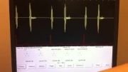 صداهای قلبی - رگورژتاسیون (نارسایی) دریچه آئورتی