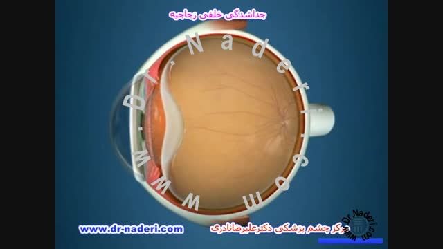 فلاشینگ یا جرقه های نورانی(PVD)- مرکز چشم دکتر نادری