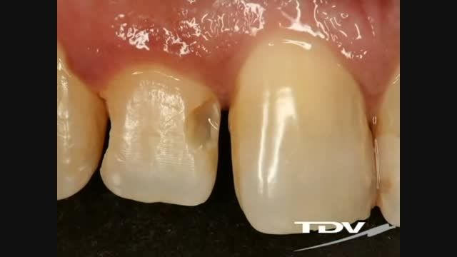 Restoration In Class III With TDV Products