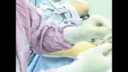جراحی Pcnl در موقعیت پهلو اولین بار در دنیا توسط دکترکرمی