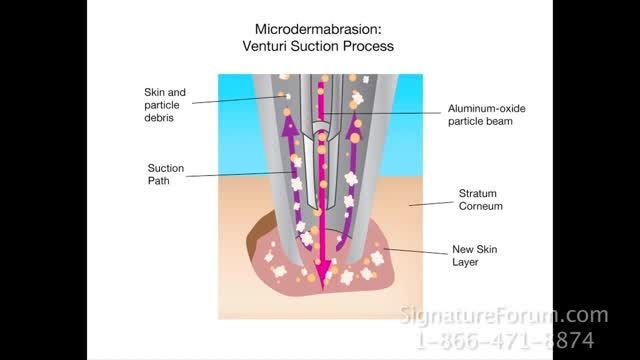 Microdermabrasion Treatment.mp4