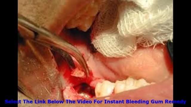 Bleeding Gums Treatment Breakthrough