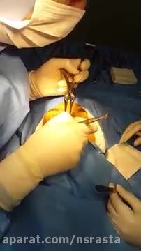 عمل جراحی بینی (3)