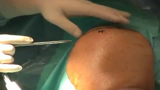 عمل جراحی