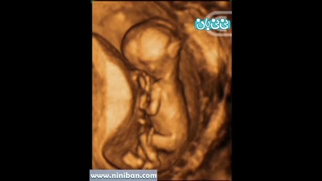 سونوگرافی چهار بعدی در بارداری هفته سیزدهم