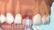 کاشت پایه دندان مصنوعی ( ایمپلنت )