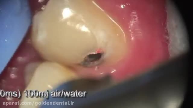 لیزر در ترمیم دندان