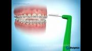 تمیز کردن دندان در ارتودنسی