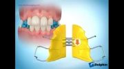 دکتر داودیان :: پلاک ارتودنسی برای افزایش عرض قوس دندانی