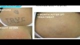 Laser Tattoo Removal Before and After Photos