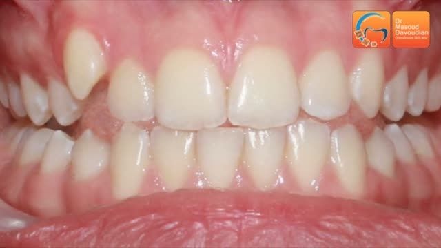 قبل و بعد ارتودنسی دندان نیش بیرون زده | دکتر داودیان