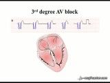 ‪31 ECGTeacher.com - Atrio-Ventricular Block (Section 5_ Part 1)