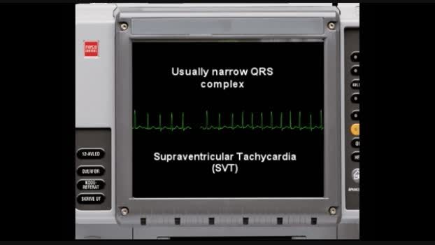 supraventricular-tachycardia-EKG
