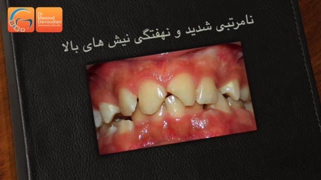 قبل و بعد ارتودنسی دندان نیش نهفته | دکتر مسعود داودیان