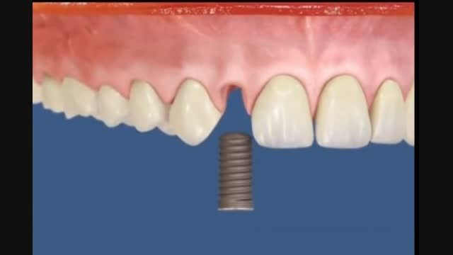 ایمپلنت دندان های جلو مرکز دندانپزشکی وزیبایی دکتر زهدی