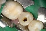 Access Preparations Mandibular Premolars