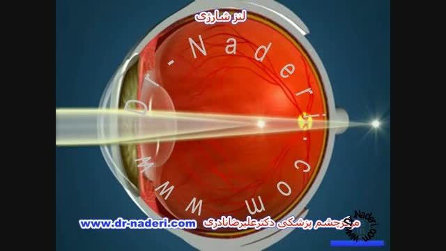 لنز ارتوکراتولوژی - مرکز چشم پزشکی دکتر علیرضا نادری