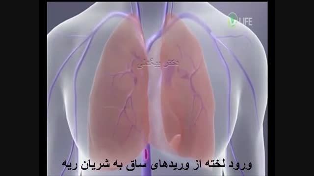 انیمیشن آمبولی ریه - لخته ورید عمقی ۱