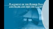 Placement of rubber dam and frame then clamp