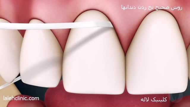 روش صحیح نخ زدن دندان