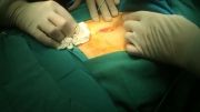عمل جراحی باز پروستات