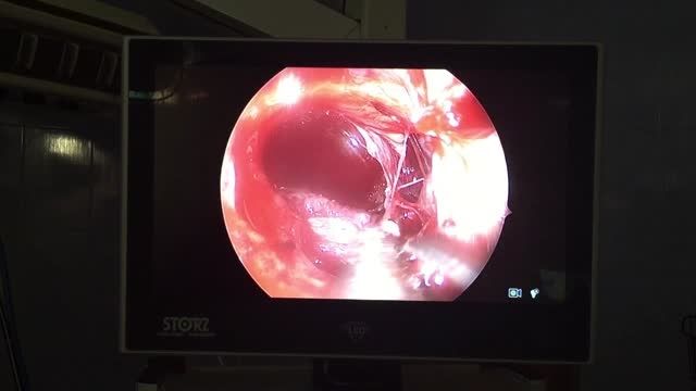 جراحی اندوسکوپ تومور مغزی کرانیو فارنژیوما از راه بینی