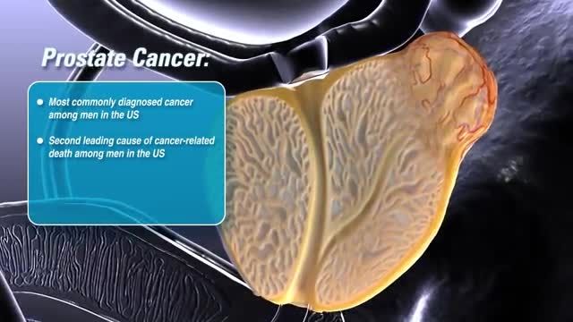 انیمیشن سرطان پروستات