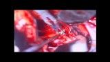 جراحی میکروسکپی انوریسم مغزی-Anterior Com. Aneurysm Clipping