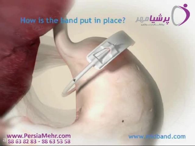 جراحی چاقی- کاربرد حلقه معده