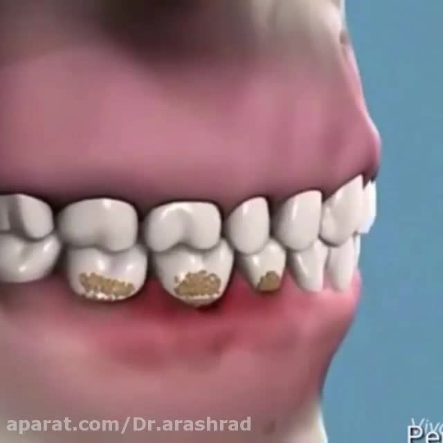 جرم گیری دندانها و لثه در یک نگاه