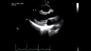 اکوکاردیوگرافی دوبعدی بلادرنگ یک قلب نرمال (الف) - Real-time two-dimensional echocardiography (a)