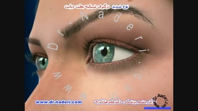 نوع شدید اثر دیابت بر شبکیه - مرکزچشم پزشکی دکترنادری