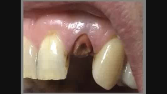 بازسازی دندان با استفاده از پست تیتانیوم
